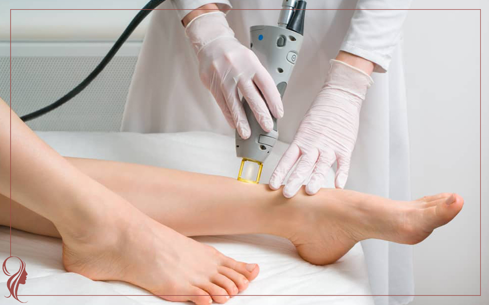 لیزر موهای زائد پا